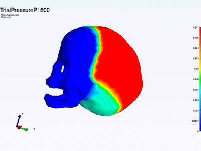 Finite Element  Model Of Fetal Skull During First Stage Of Labour